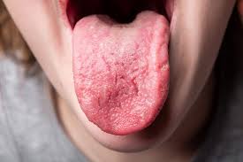 Tongue Ridges